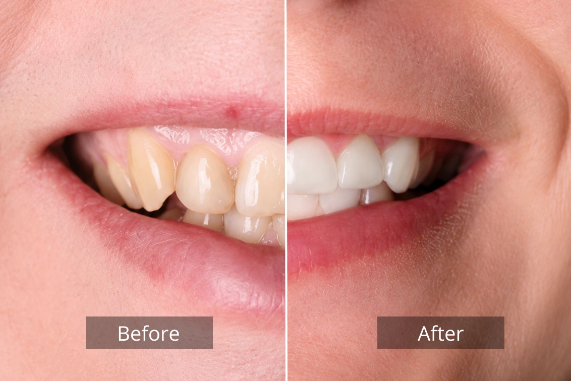 dental implants before after 3