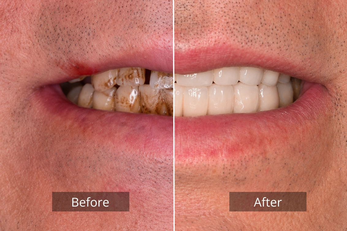 dental implants before after 5