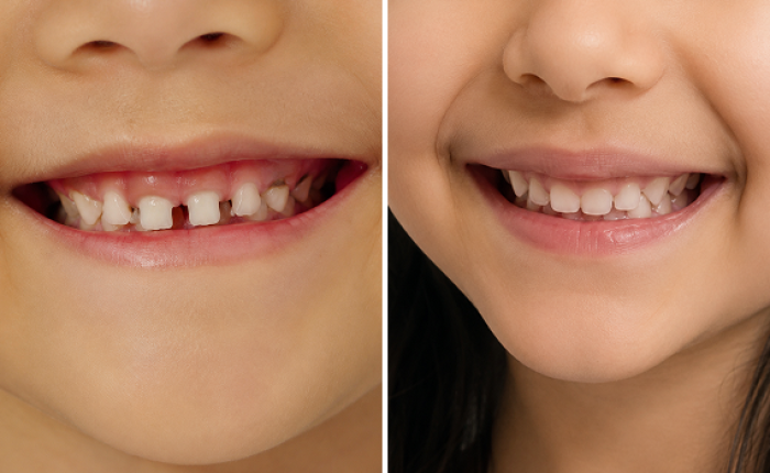 Before and after photo of pediatric dental treatment, case 4