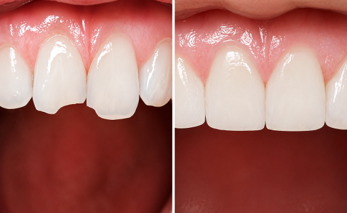 Before and after photo of pediatric dental treatment, case 3