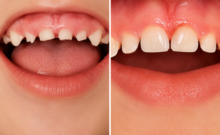 Before and after photo of pediatric dental treatment, case 2