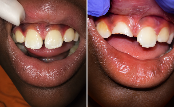 Before and after photo of pediatric dental treatment, case 1